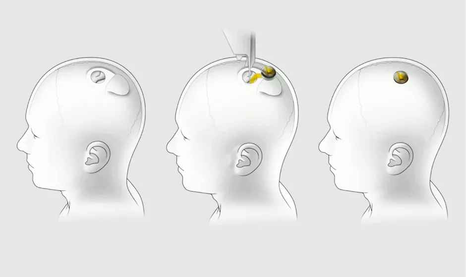 Transhumanismo, libertad y proyecto personal — imagen